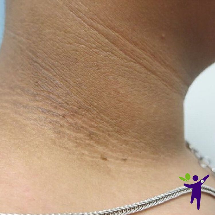 Acanthosis Nigracans Symptoms - What Is It And Why Does It Matter?