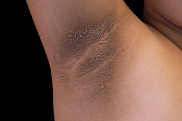 Acanthosis Nigracans - What Is It And Why Does Tt matter? Acanthosis Nigracans - What Is It And Why Does Tt matter?