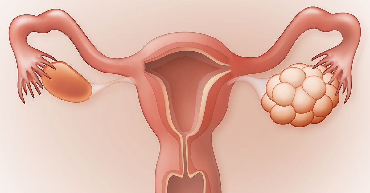 What is pcos ? What is pcos ?