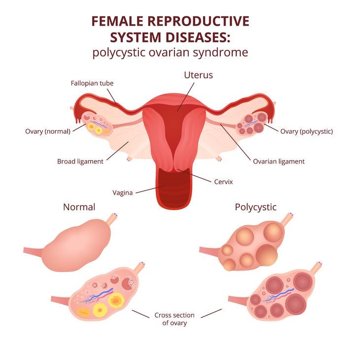 What causes PCOS ?