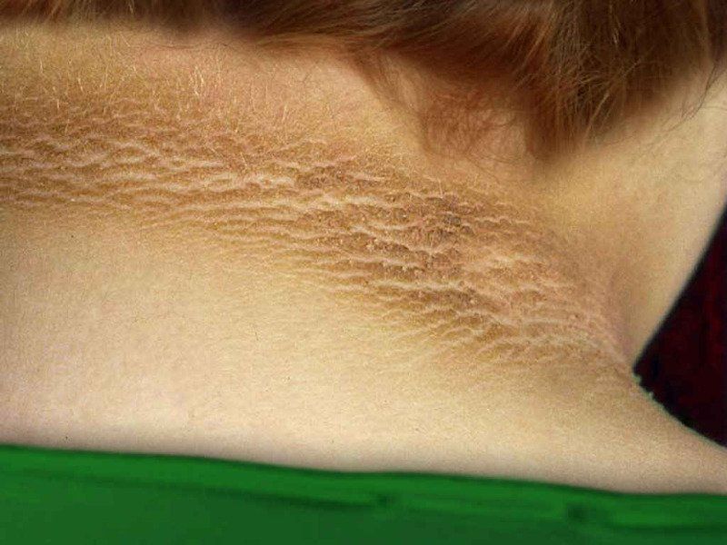 What causes Acanthosis Nigricans ?