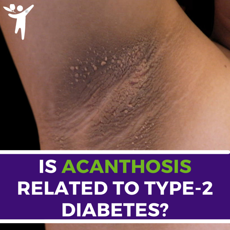 How do you know if you have Acanthosis Nigricans? How do you know if you have Acanthosis Nigricans?