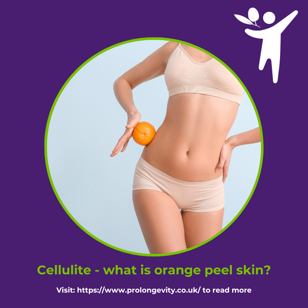 What Causes Cellulite?